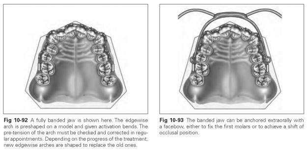 Orthodontic archwire - Wikipedia