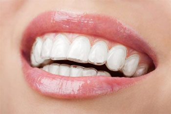 Whitening Gels