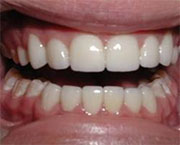 Neglected caries. What to do with this problem?
