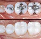 What are the kinds and types of fillings?