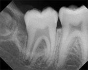 Dental cyst. How is it formed, how to cure it? What are the consequences? 
