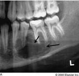 Dental cyst maxillary sinus
