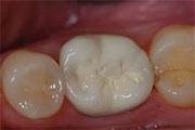 Restore enamel on front teeth