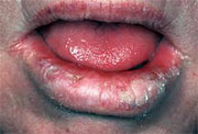 Lip cancer symptoms