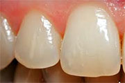 Restore tooth enamel mouthwash