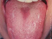 Candidiasis of the oral cavity