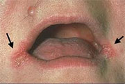 Cheilitis pathology