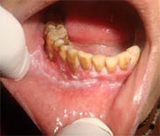 Leukoplakia of the mouth cavity. How to treat leukoplakia of the mouth cavity?