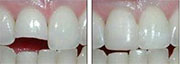Restoration teeth