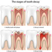 Multi-Vitamins Fight Tooth Decay