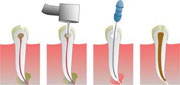 What a Root Canal Procedure Accomplishes
