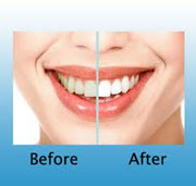 Teeth Whitening At the Dentist's and At Home