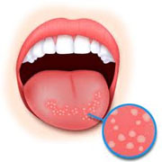 Treat denture stomatitis