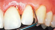 How to cure periodontitis at home?