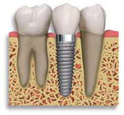 How do dental implants cost?