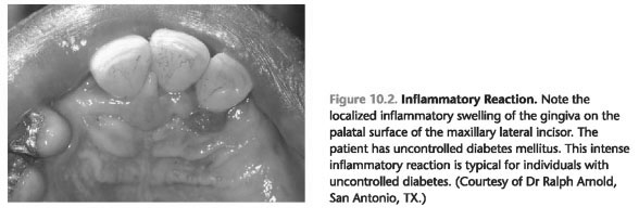 Diabetes and periodontitis