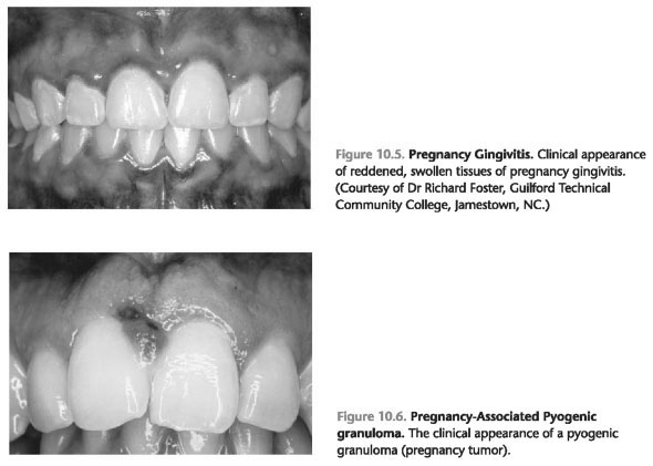 Pregnancy gingivitis cause