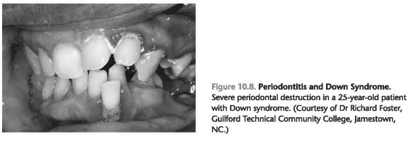 Periodontal disease and down syndrome