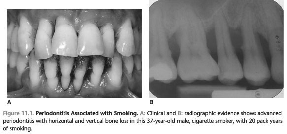Smoking periodontal disease and the role of the dental profession