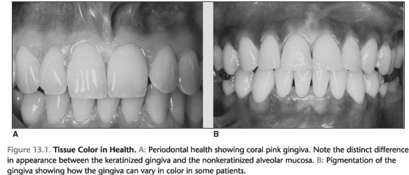 Healthy gingiva appearance