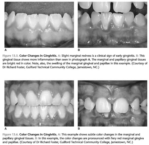 Clinical characteristics of gingivitis