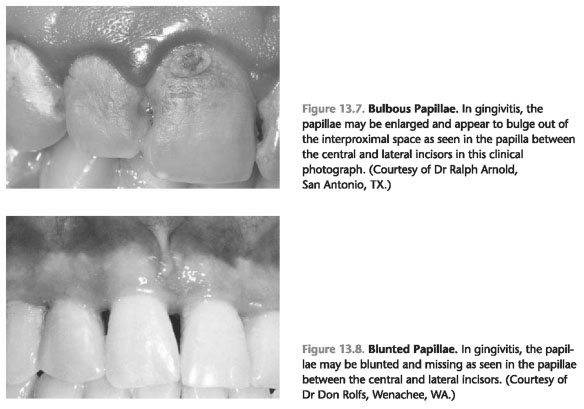 Clinical characteristics of gingivitis