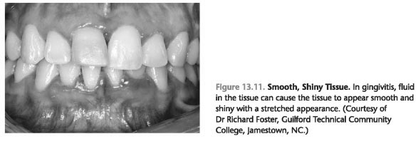 Tissue Consistency and Texture in Gingivitis