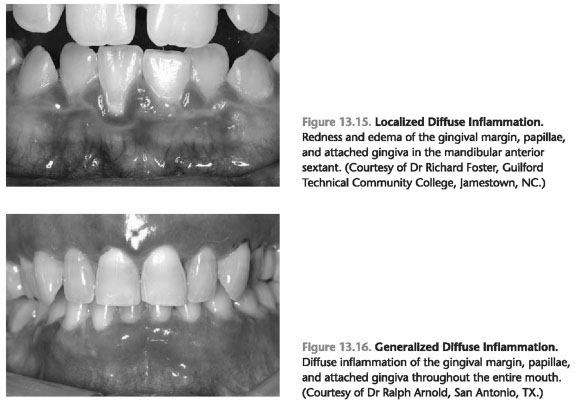 Gingival inflammation index