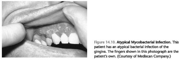 Non plaque induced gingivitis ppt