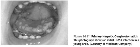 Primary herpetic gingivostomatitis treatment