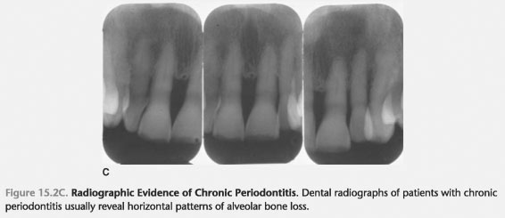 Characteristics of Chronic Periodontitis