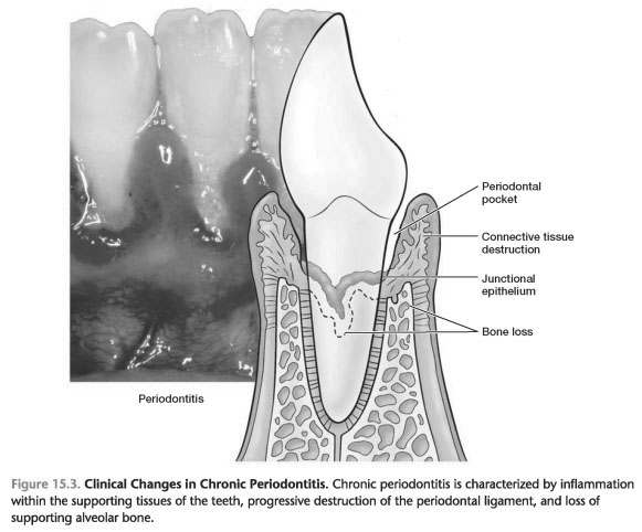Characteristics of chronic periodontitis