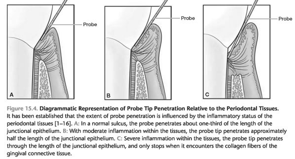 Characteristics of chronic periodontitis