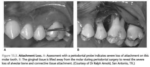 Characteristics hiv periodontitis