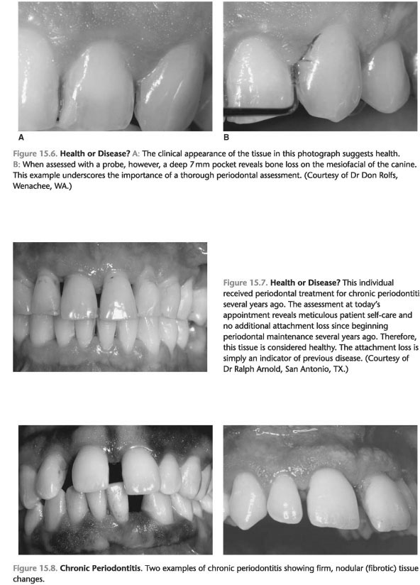 Early onset periodontitis