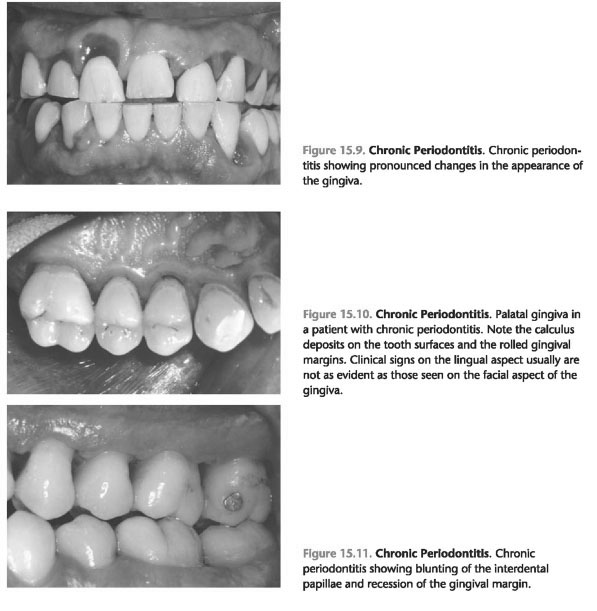 Early onset periodontitis in the united states of America