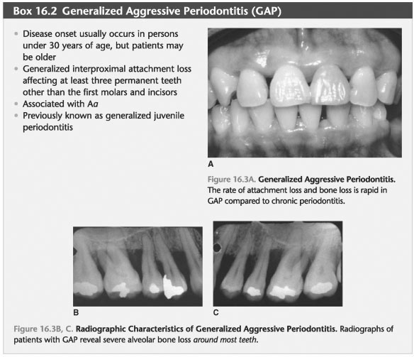 Generalized aggressive periodontitis primary teeth