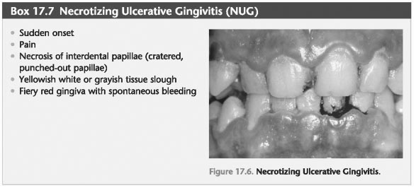 Necrotizing Periodontal Diseases