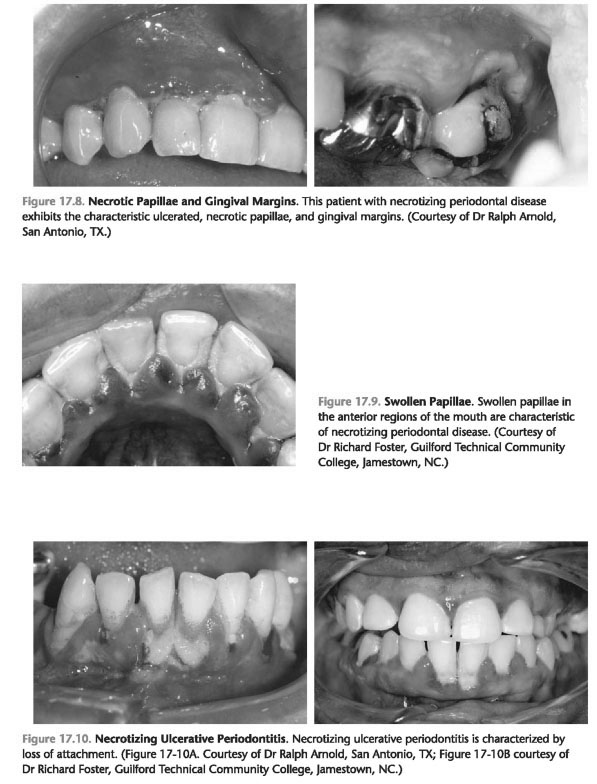 Periodontal diseases ppt