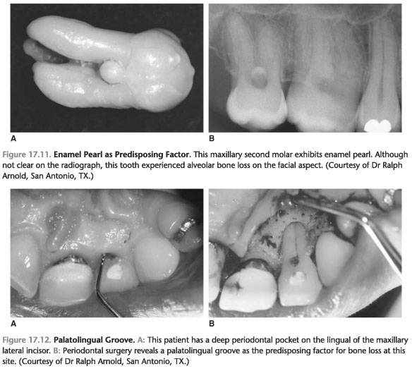 Risk factors gum disease