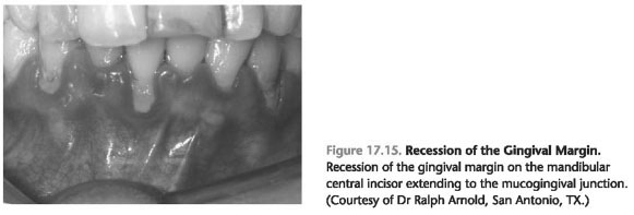 Mucogingival deformities and conditions around teeth
