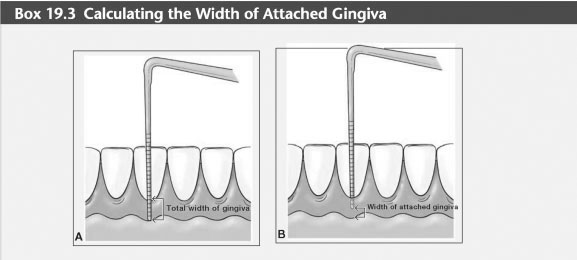 Attached gingiva keratinized