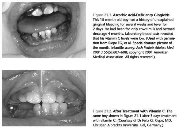 Role of diet in periodontal disease