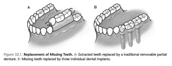 Anatomy of the Dental Implant