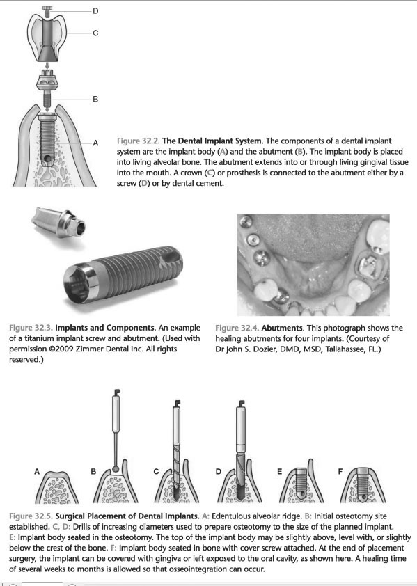 Anatomy of the Dental Implant