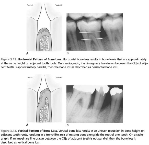 Bone loss periodontal pockets
