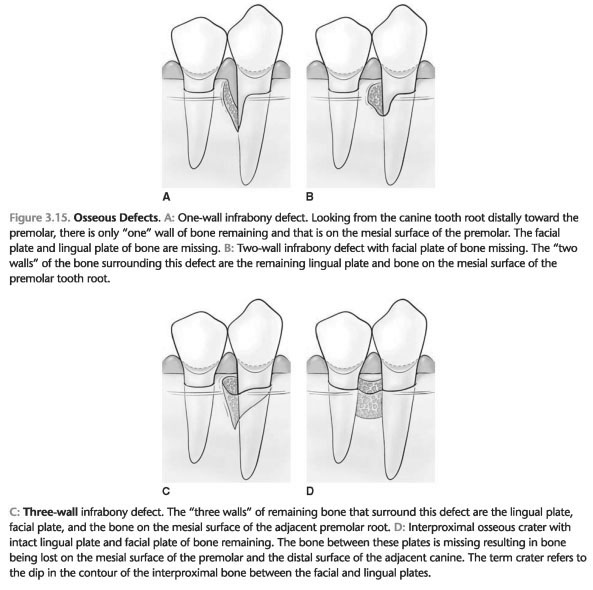 Bone Defects in Periodontal Disease