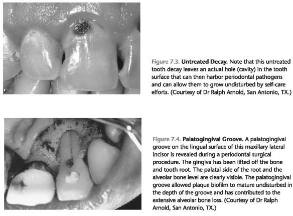 Tooth Grooves or Concavities