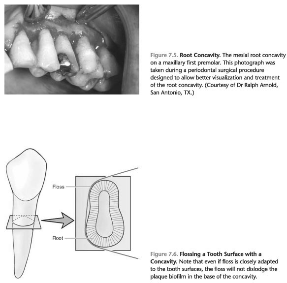 Tooth developmental grooves