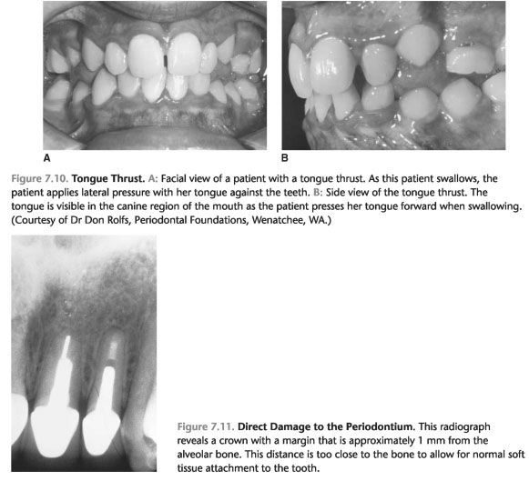 Tooth preparation for complete crowns